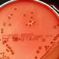 MDR Antibiotic Resistant Superbugs - Treatment-Resistant Gonorrhea
